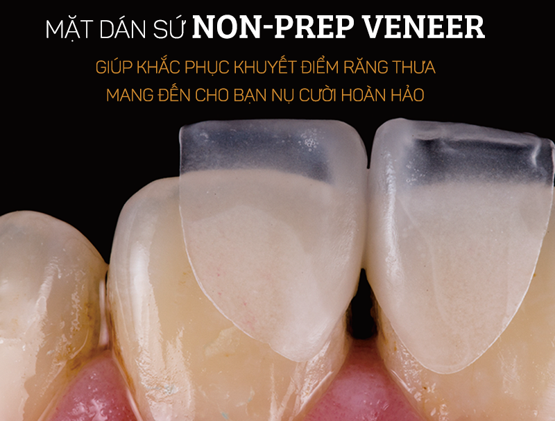 Veneer Non-Prep (không mài)